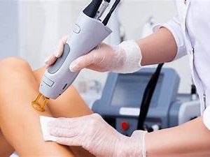 Cagnotte épilation laser