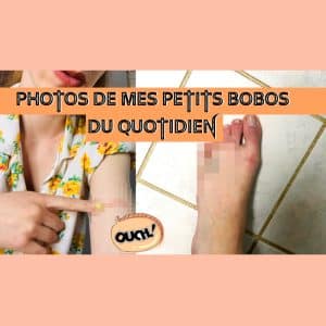 𝗣𝗛𝗢𝗧𝗢𝗦 : Mes petits bobos du quotidien 🤕💖