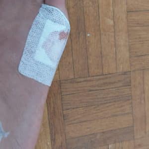 Photos pieds avec points de souture